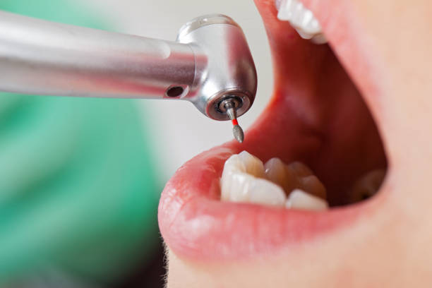 Best Knocked-Out Tooth (Avulsed Tooth) Treatment in Fort Belknap Agency, MT
